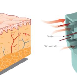 Mezoterapia prozniowa (VITAL INJECTOR 2)